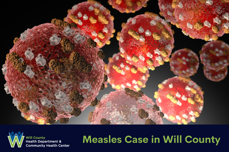 Will County Health Department Announces Positive Case Of Measles In Will County 