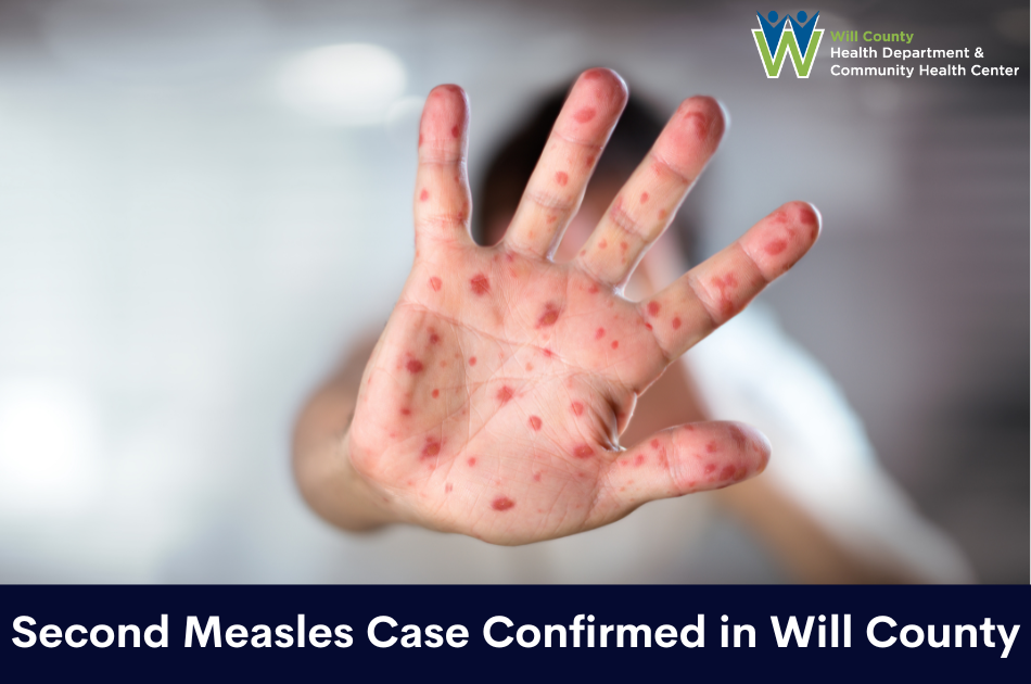 The Will County Health Department (WCHD) has confirmed an additional positive case of measles in Will County